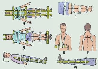 иммобилизация